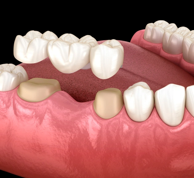 Custom dental bridge services near Brandon and Apollo Beach at Valley Dental Riverview