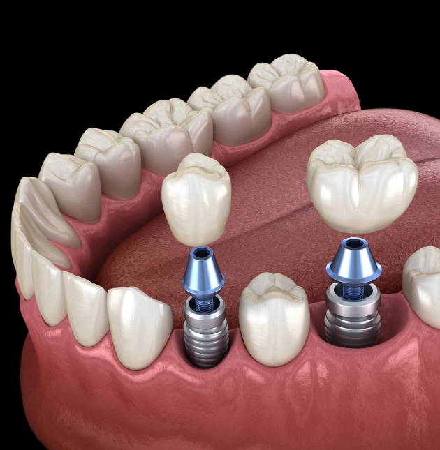 close view of dental implant procedure done at Valley Dental Riverview